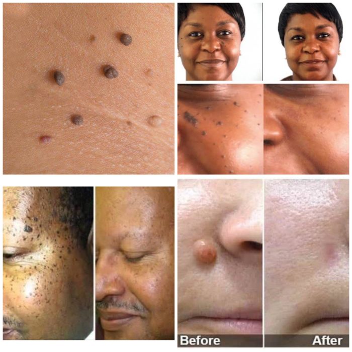 Skin Tags Removal